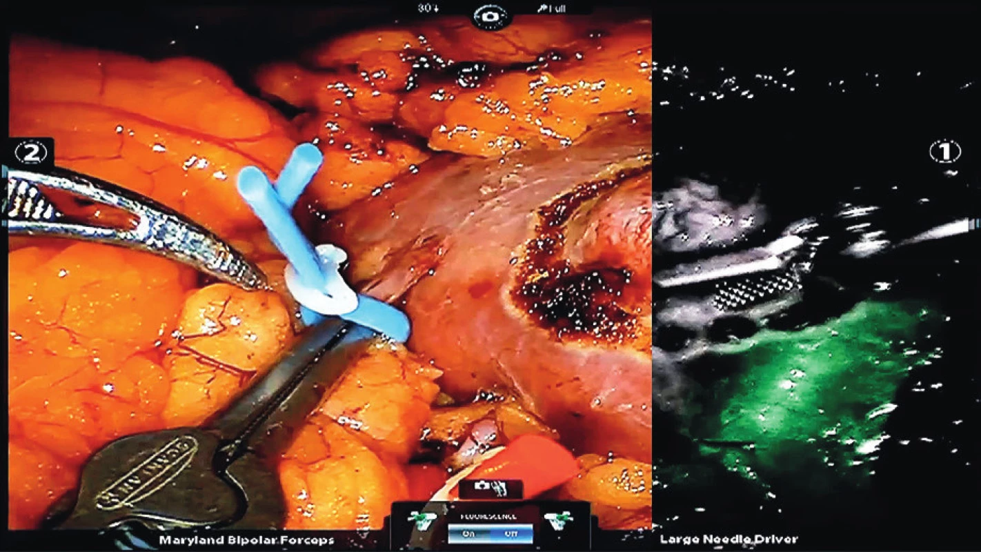 Zobrazení prokrvení ledviny pomocí fluorescenční
kamery s použitím indocyaninové zeleně (tmavá oblast
neprokrvená, zelená prokrvená)