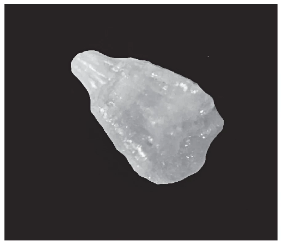 Fragment of analyzed renal stone (dimensions 2 x 1
millimeter)