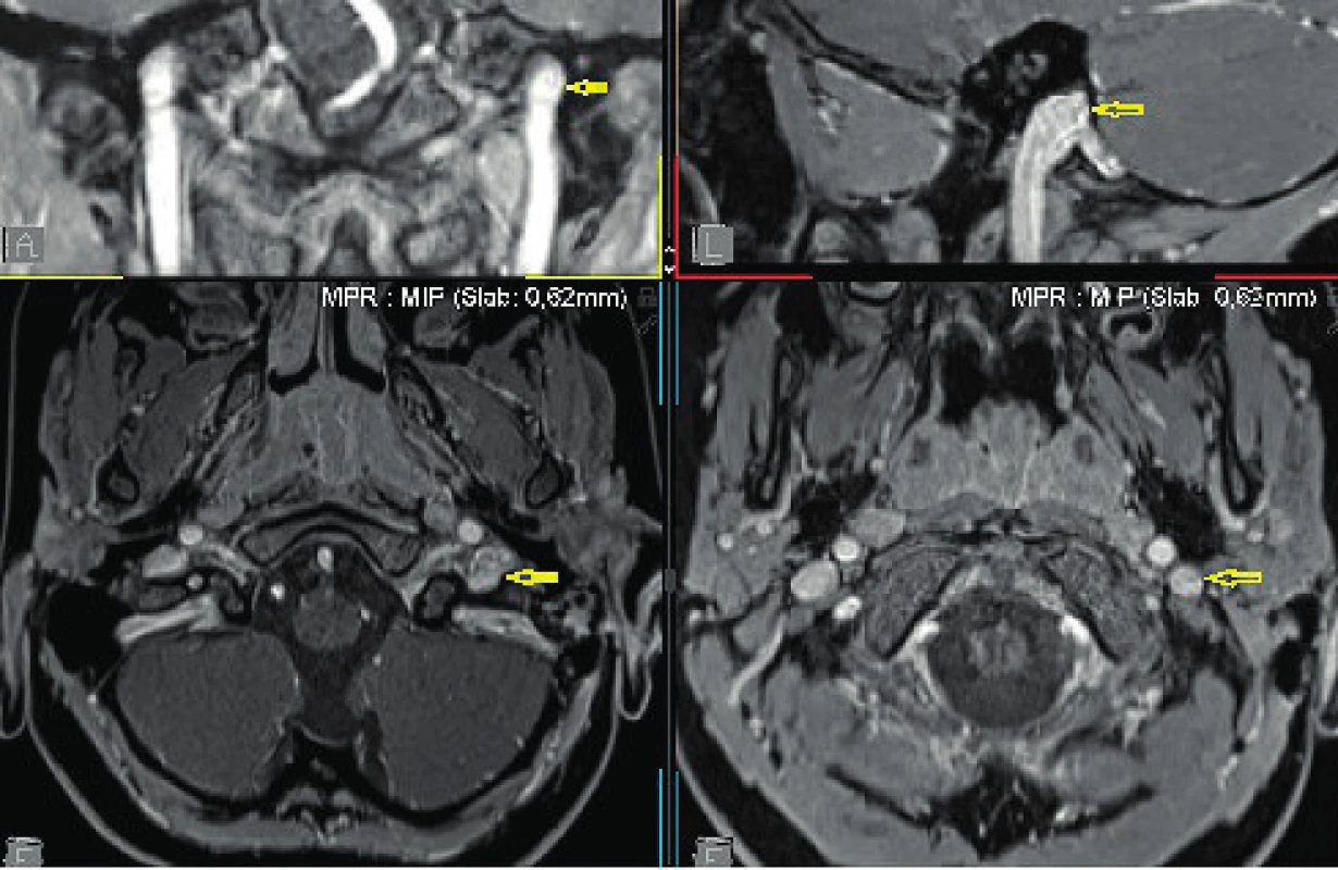 MRI, T1 vážená sekvence, pooperačně, rekanalizace
bulbu v. jugularis interna vlevo, v náplni již není patrný defekt