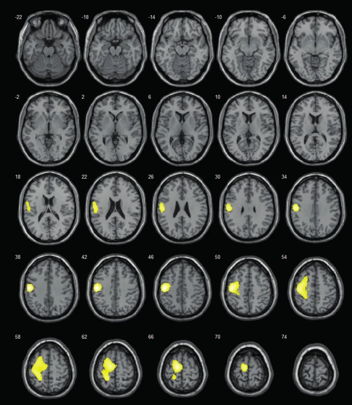SISCOM – lokalizuje do levé frontální krajiny (v době vyšetření 14letá
pacientka s farmakorezistentní epilepsií levého frontálního laloku; zóna
počátku záchvatů dominantně v oblasti primárního motorického kortexu
– verifikováno při následné invazivní EEG monitoraci pomocí subdurálního
gridu; resekční výkon neindikován z důvodu jisté pooperační hemiparézy).<br>
Fig. 1. SISCOM – localizes to the left frontal area (at the time of examination 14-y
old girl with refractory left-sided frontal-lobe epilepsy; seizure onset zone
predominantly in primary motor cortex – verified by subsequent invasive
EEG exploration using subdural grid; resection was not performed for certain
right-sided paretic deficit).