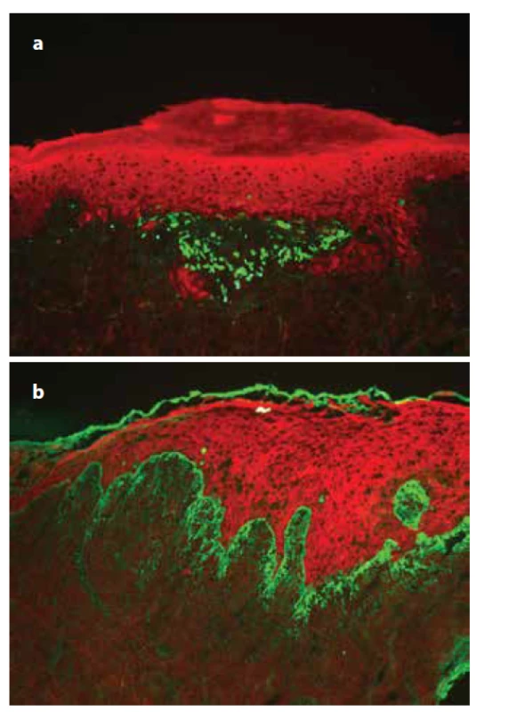 Přímá imunofluorescence lichen planus<br>
a) pruhovitá, cárovitá imunofluorescence fibrinogenu podél
bazální membrány,<br>
b) IgM pozitivní cytoidní tělíska ve shlucích subepidermálně
