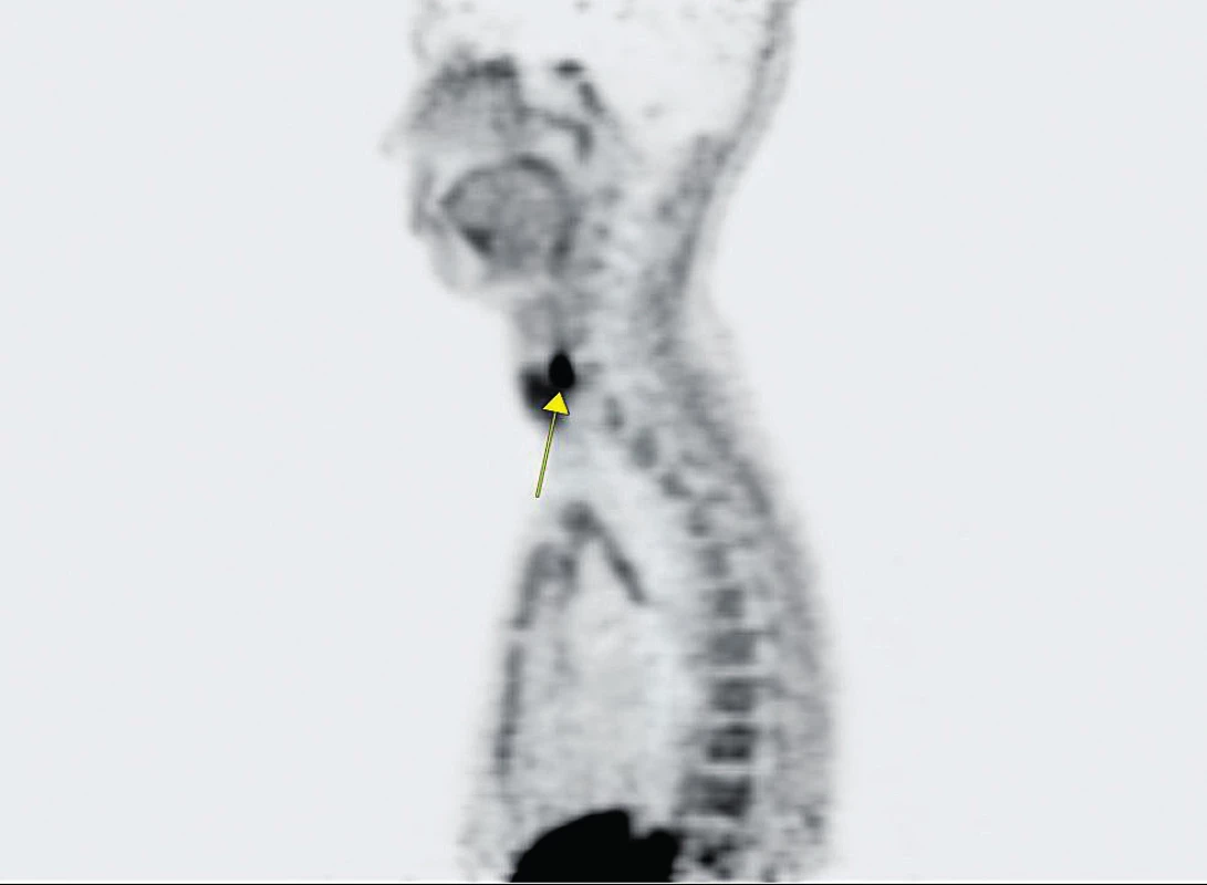Sagitální rovina PET (pozitronové emisní tomografie)
po aplikaci 18fluorcholinu (18-FCH)
Šipka označuje místo zvýšené akumulace radiofarmaka, tedy na oblast
hyperfunkčního příštítného tělíska
