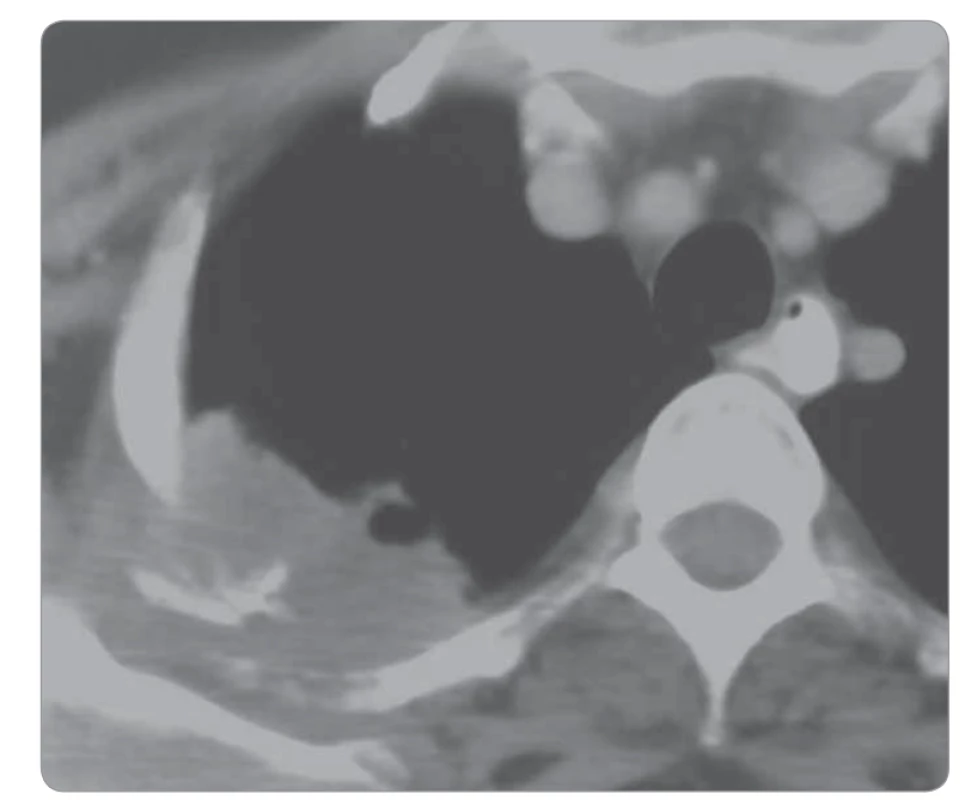 Karcinom plic v oblasti vrcholu pravé plíce.