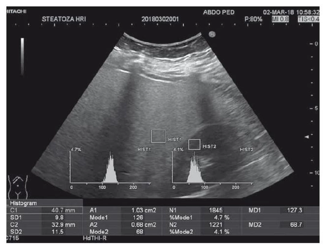 Hodnotenie steatózy pečene u obéznych pediatrických pacientov pomocou
ultrasonografie (HRI  1,85).<br>
Fig. 1. Evaluation of liver steatosis in obese paediatric patients using
ultrasonography (HRI 1,85)