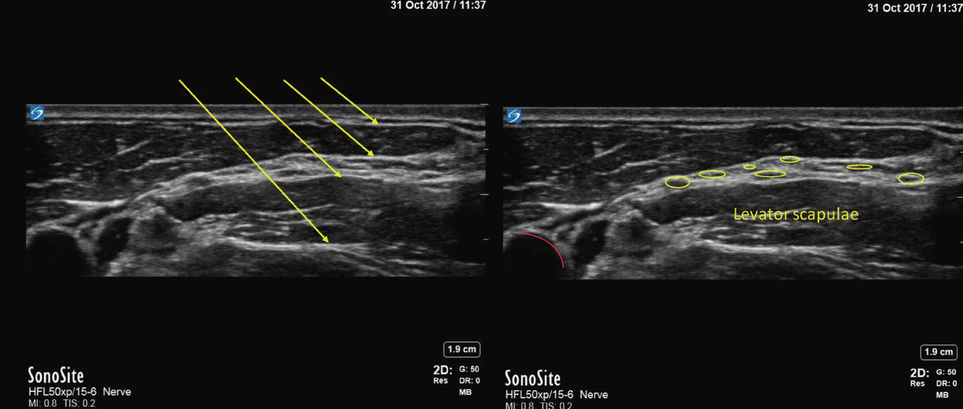 Obraz cervikálního plexu, na levé části obrázku jsou šipkami zvýrazněné svalové fascie, na pravé části jsou zvýrazněné
nervy cervikálního plexu