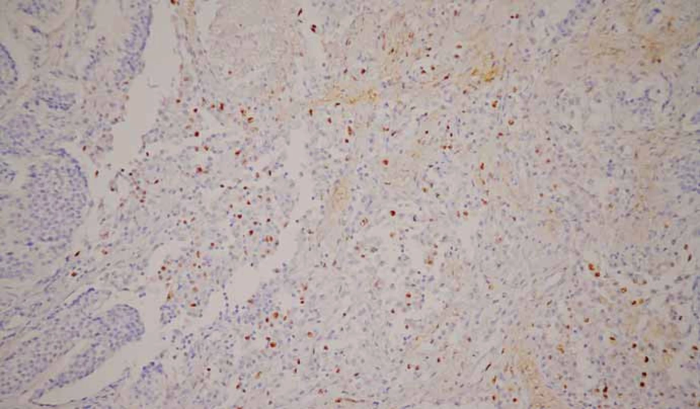 Neuroendokrinný nádor G2. Imunohistochemické vyšetrenie s protilátkou proti Ki-67. Pozitivita Ki-67 2–20 %. 3,3-diaminobenzidín, 200×.