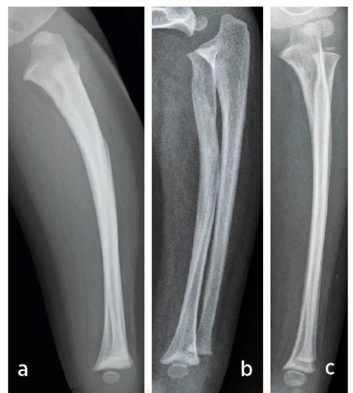 Chlapec 3 roky, zlomenina diafýzy obou kostí předloktí;
a) po sejmutí sádrové fixace zhojen ve ventrální
osové úchylce; b) po 7 měsících výrazná remodelace
skeletu; c) remodelace do anatomického postavení
po 3 letech.<br>
Fig. 2. Boy 3-year-old, diaphyseal fracture of both radius and
ulna; a) after plaster cast removing healing in ventral
axial deflection; b) seven month later well-marked bone
remodeling; c) bone remodeling to the anatomical
configuration after three years.