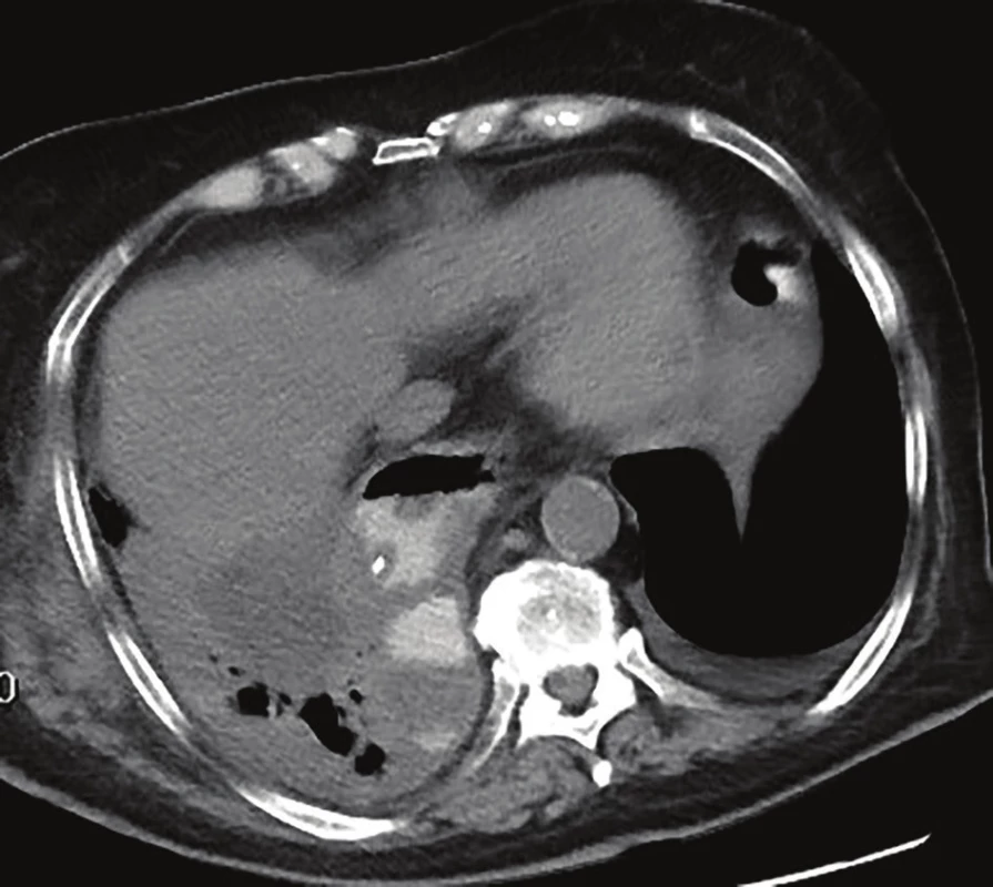 CT hrudníku – EVAC in situ v dutině paravertebrálně
vpravo<br>
Fig. 1: Chest CT – EVAC in situ in the right paravertebral cavity