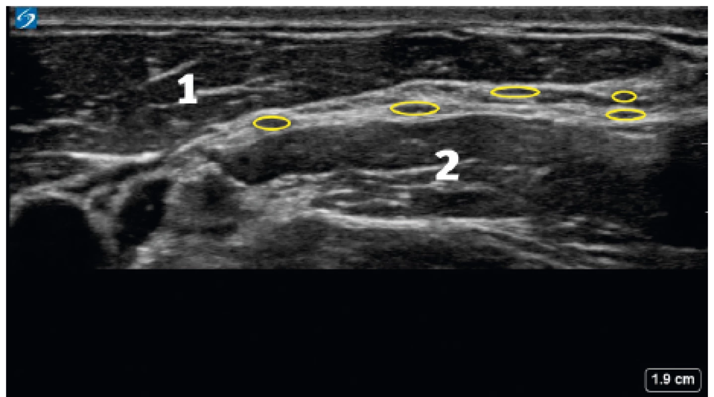 Ultrazvukový obraz cervikálního plexu