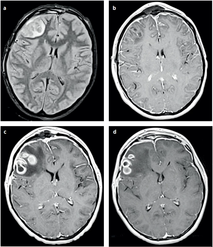 a–d (P1). NMR vyšetření hlavy, vývoj mozkového abscesu. 2. hospitalizační den (a), 4. hospitalizační den (b), 19. hospitalizační den (c), 23. hospitalizační den (d). (Za laskavého přispění MUDr. Pavla Rejtara)<br>
Fig. 4a–d (P1). Brain MRI, the development of the brain abscess. Day 2 of hospitalisation (a), Day 4 of hospitalisation (b), Day 19
of hospitalisation (c), Day 23 of hospitalisation (d). (Credit Dr. Pavel Rejtar)