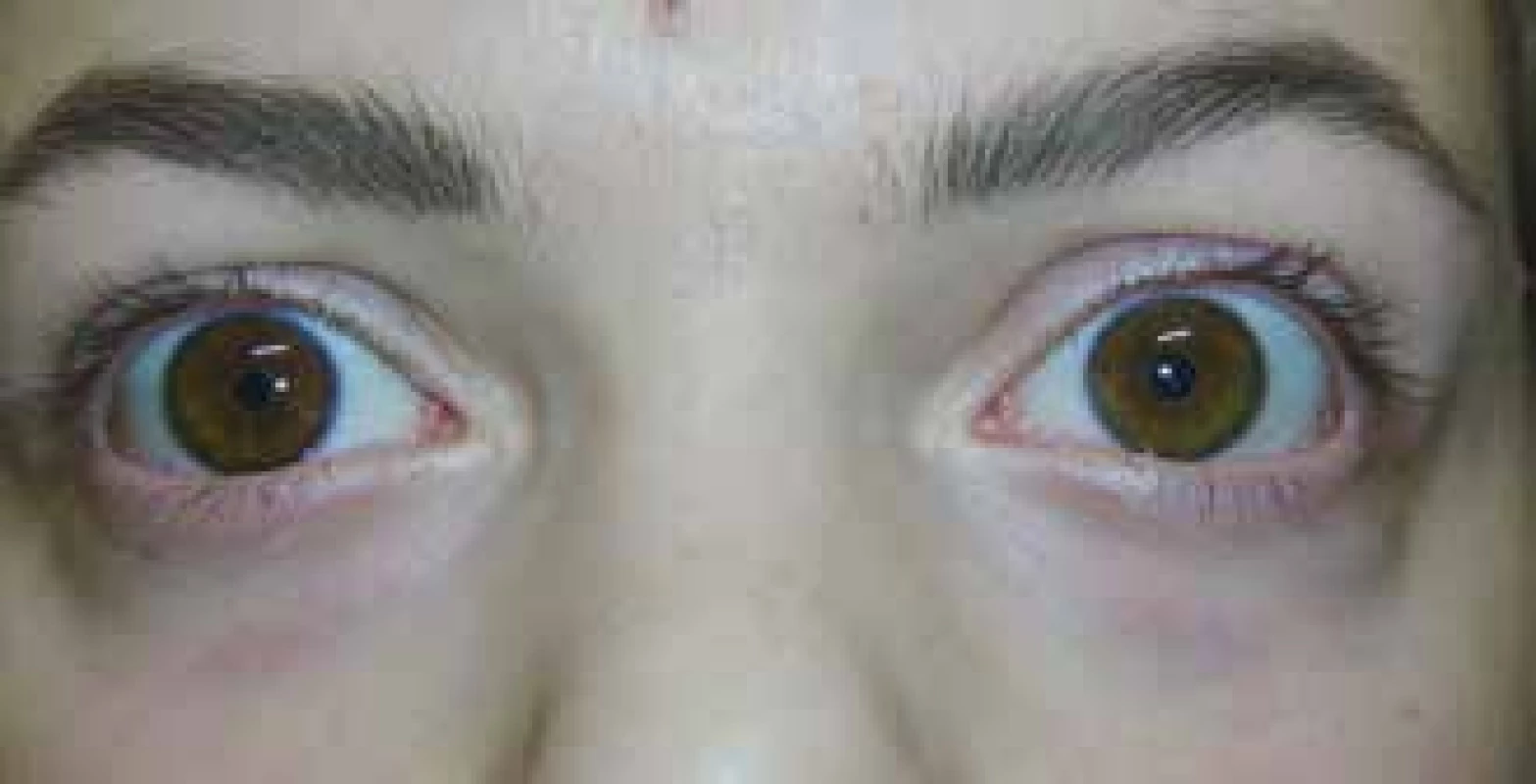 Positive result of pharmacological test with application
of 1.0% Pilocarpine in left eye