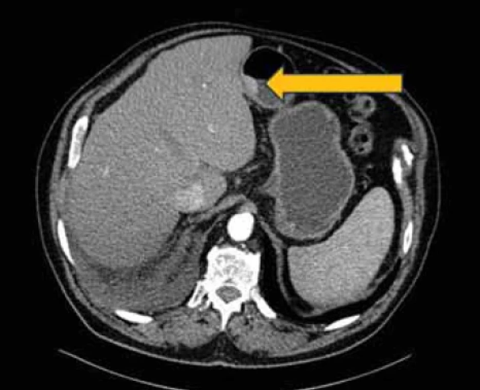 CT vyšetření břicha s tumorózní expanzí žaludku.</br>Fig. 7. CT examination of the abdomen with tumorous expansion of the stomach.