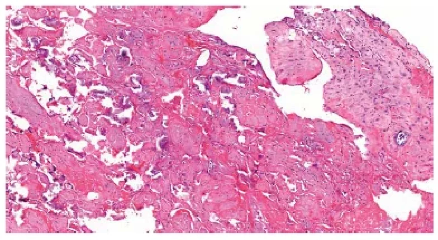 Residua post partum. Těhotenská decidua a regresivně změněné části
placentární tkáně (HE, 100x).
