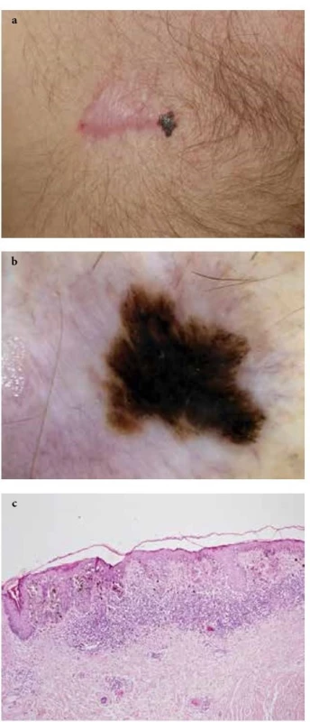  a-c. Recidiva tenkého maligního melanomu<br>
(Breslow 0,1 mm) v jizvě po předchozí chirurgické excizi