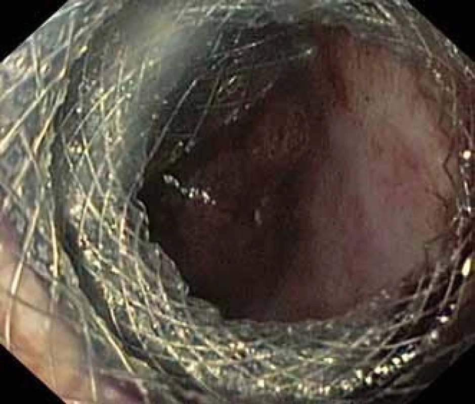 Dutina pseudocysty se zavedeným stentem HOT AXIOS™ a viditelnými vlákny Niti-S NAGI™ stentu.<br> Fig. 2. Pseudocyst cavity with a HOT AXIOS™ stent and visible fibres of a Niti-S NAGI™ stent.
