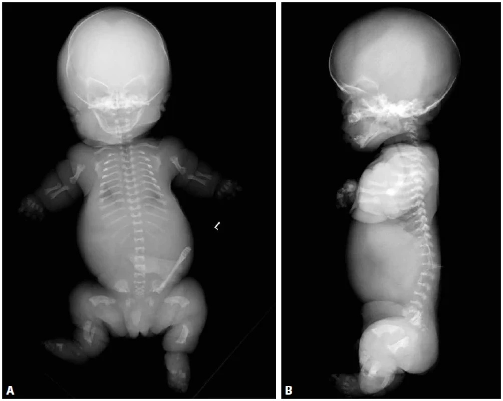 A: Thanatoforická dysplázie typu 1, novorozenec 39. týden, RTG předozadní projekce. Platyspondylie. Úzký hrudník. Krátké a široké dlouhé
tubulární kosti. Ohyb femurů ve tvaru telefonního sluchátka. B: RTG bočná projekce. Vyniká platyspondylie tj. snížená obratlová těla s relativním
rozšířením meziobratlových prostor.