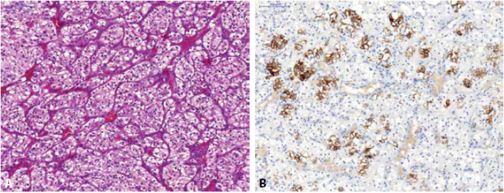 Low-grade světlobuněčný renální karcinom (A), fokálně vykazující pozitivitu barvení s cytokeratinem CK7 (B).