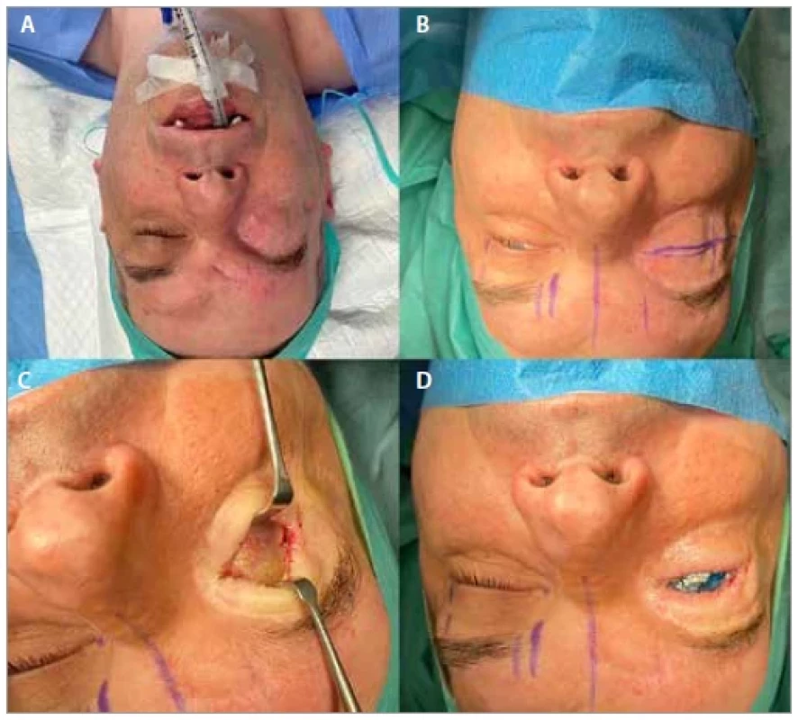 (A) State before the eyelids reconstruction; (B) surgical markings;
(C) opening of the conjuctival sac; (D) temporary eye prosthesis.