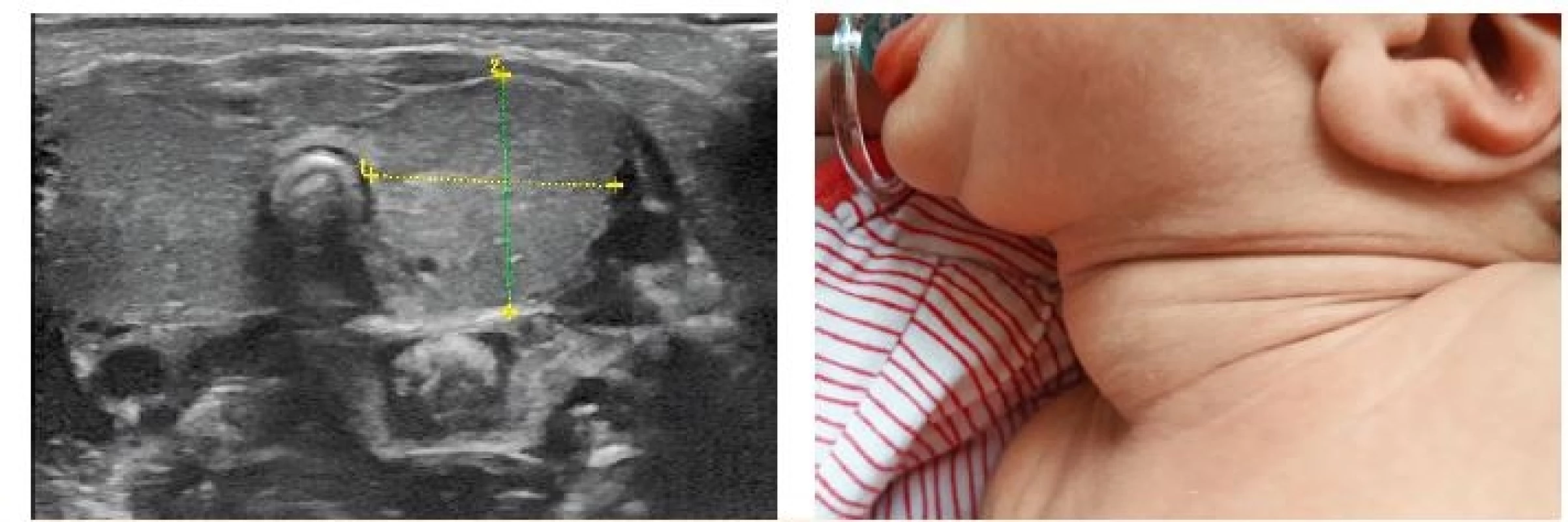 Vlevo ultrazvukový nález rozsáhlé novorozenecké strumy – objem 6 ml, norma pro novorozence kolem 0,6 ml (z archivu MUDr. Jaroslava Zikmunda, CSc.). Vpravo odpovídající fyzikální nález (z archivu autorky, se souhlasem rodičů).<br> Fig. 5. Left: ultrasound of a large neonatal goiter – volume 6 ml, normal neonatal thyroid volume about 0.6 ml (provided by MUDr. Jaroslav Zikmund, CSc.). Right: corresponding clinical presentation (with parental consent).