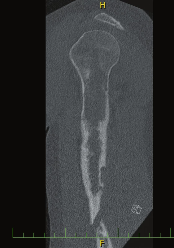 Na plnohodnotném CT levého humeru byla zobrazena
nepravidelná nehomogenní projasnění ve spongióze
s ojedinělou tečkovitou kalcifikací a s nepravidelným ztenčením
kortikalis, ve které jsou i defekty, a s patologickou frakturou
ve střední třetině diafýzy.