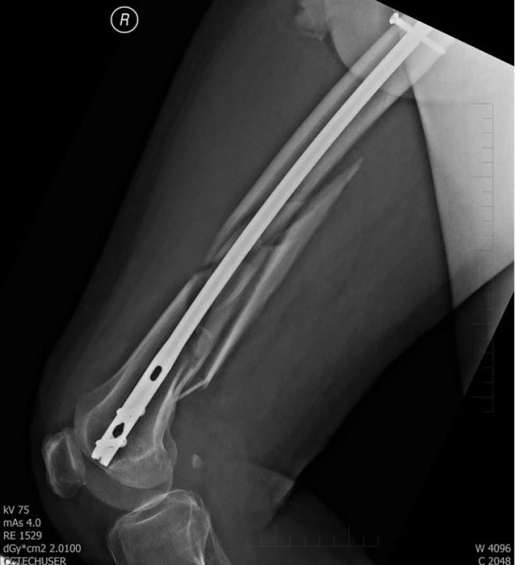 Pooperační rtg stehenní kosti vpravo
– stav po nitrodřeňové osteosyntéze femuru