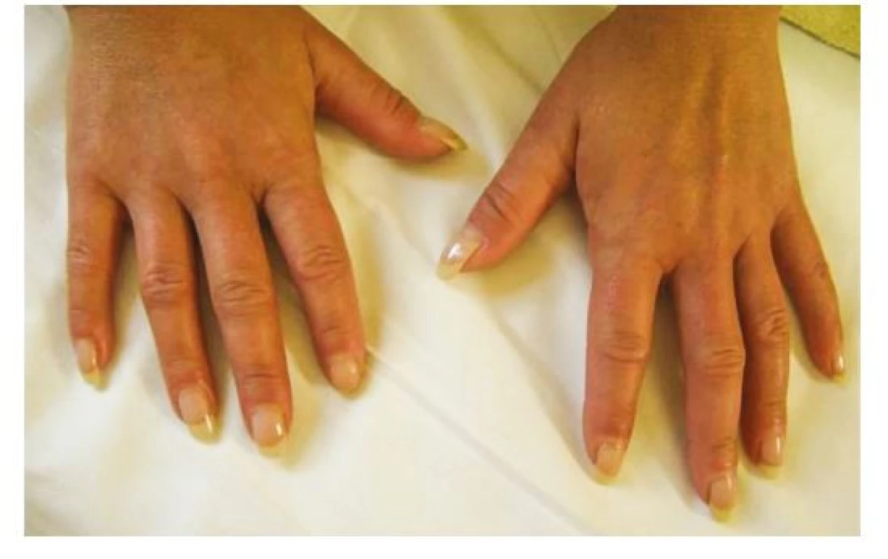 Difuzní prosak prstů u 40leté ženy – puffy fingers