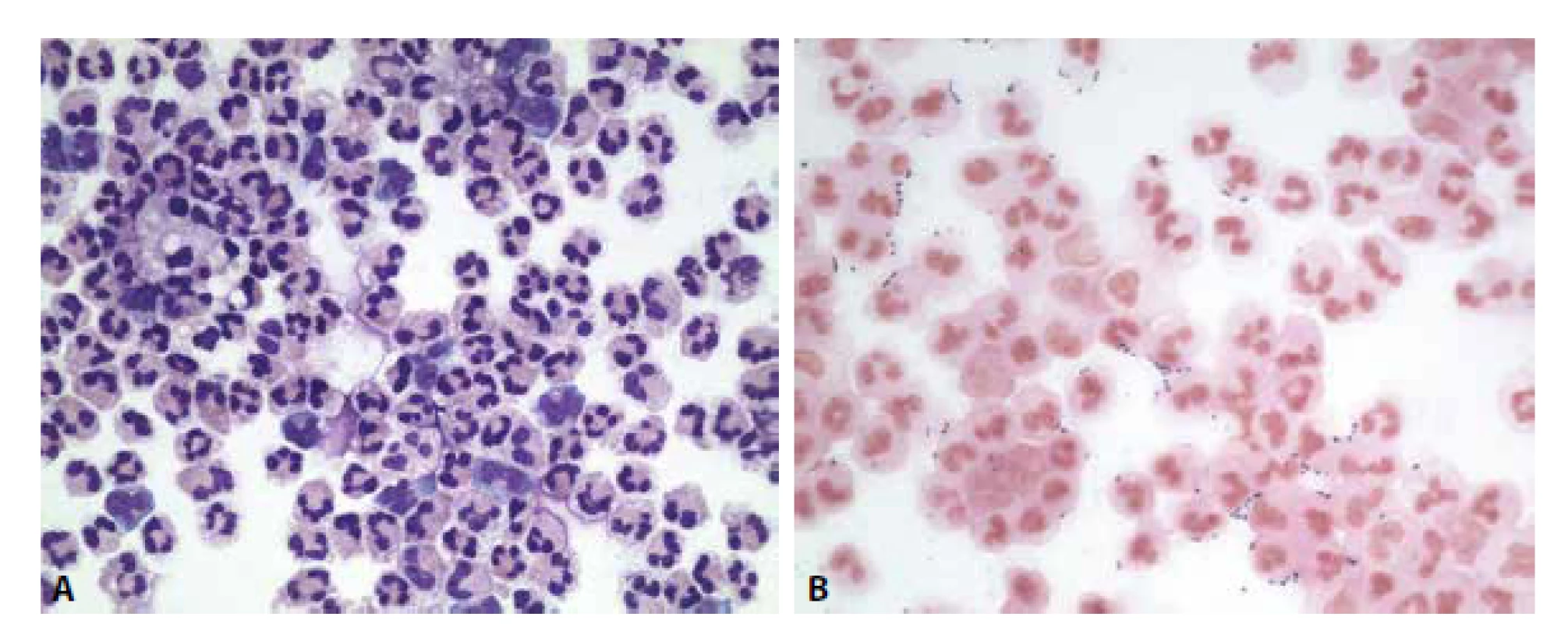 Ilustrační případ 1. Hnisavá meningitis. (A) Neutrofilně granulocytární pleocytóza. MGG, 400x. (B) Extra- i intracelulární přítomnost
diplokoků. Gram. 400x.