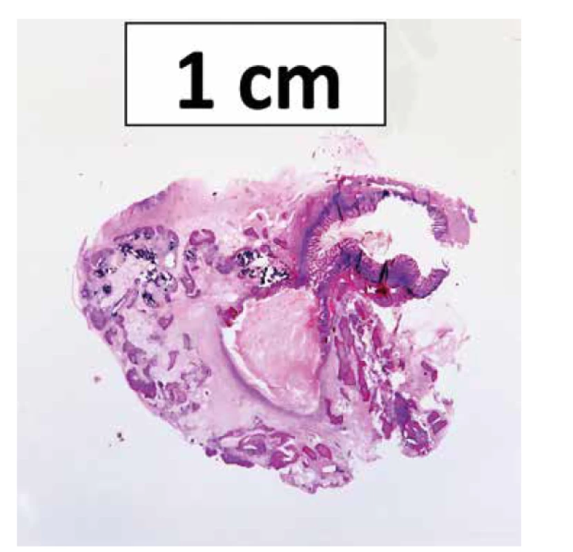 Histotopogram kalcifikovaného Meckelovho divertikula s oseálnou
metapláziou.