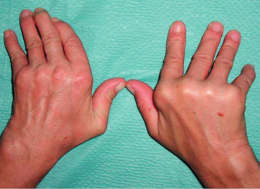 Deformity rukou typu Jaccoudovy artropatie
u systémového lupus erythematodes (archiv II. interní GE
kliniky LF UK a FN, Hradec Králové – vlastní pozorování)