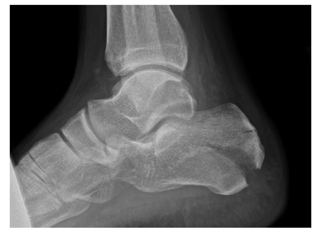Rentgenový snímek zlomeniny patní kosti typu
kachního zobáku podle Essex-Loprestiho<br>
Fig. 1: Plain radiograph of calcaneal fracture, Essex-
-Lopresti tongue type