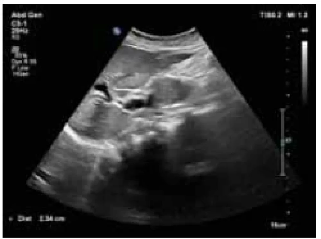 UZ břicha – hraniční šíře hlavy
pankreatu. <br> 
Fig. 2. Abdominal ultrasound – boundary
width of the head of the pancreas.