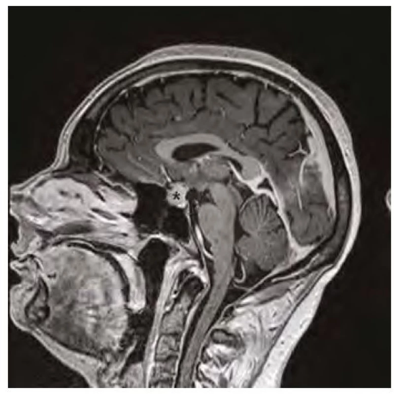 Magnetická rezonance mozku v sagitálním řezu v postkontrastním
T1-váženém obraze, hvězdička označuje zvětšenou hypofýzu před zahájením
substituční léčby hypotyreózy