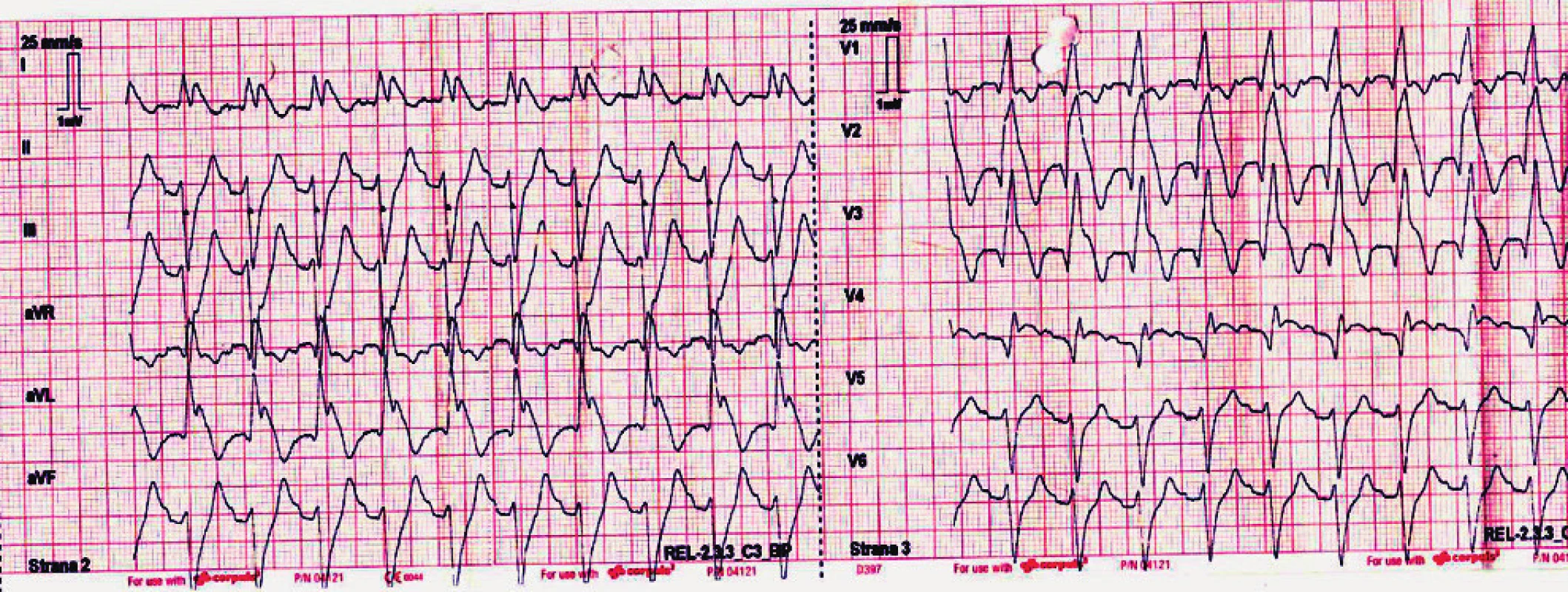 EKG křivka v průběhu primárního ošetření na místě. Popis EKG křivky je uveden v textu