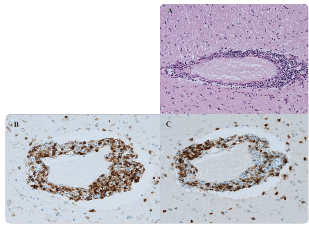 Histologické vyšetření bazálních ganglií (zvětšení 100×).<br>
A. Hematoxylin-eozinové barvení perivaskulární infi ltrace.<br>
B. Imunohistochemické barvení perivaskulární oblasti pomocí CD4.<br>
C. CD8 znaku.