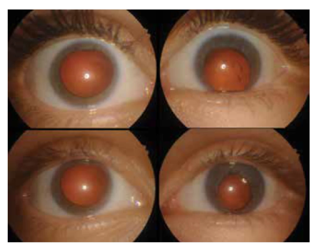 Přední segment očí po zhojení úrazu (nahoře) a po
operaci traumatické katarakty levého oka (dole)