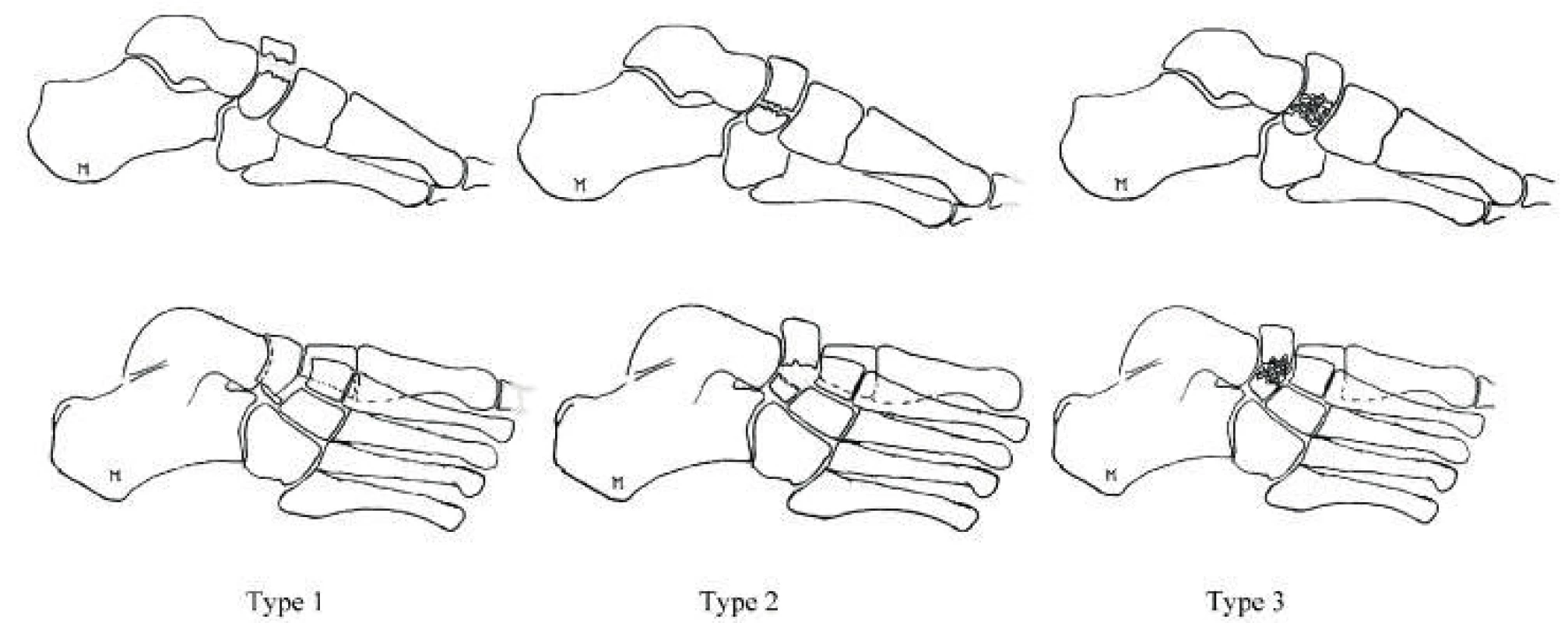 DeLee’s Navicular Bone Fractures (Source. Moore Derek. Tarsal
navicular Fractures: https://www.orthobullets.com/foot-and-ankle/7033/
tarsal-navicular-fractures)