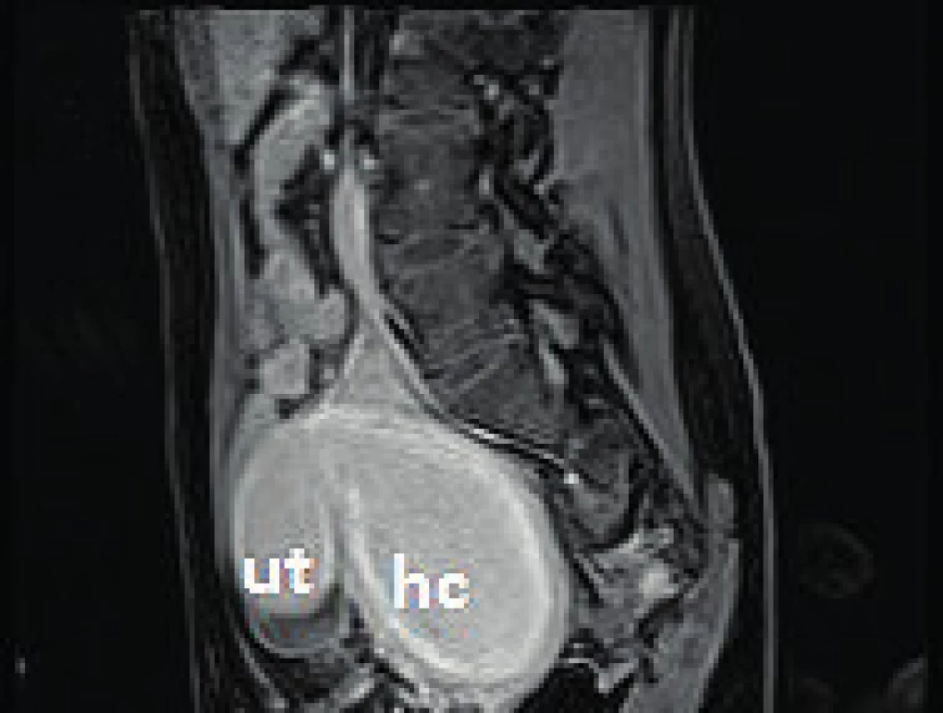 MRI snímek pánve T1 s kontrastem v sagitální projekci
ut – uterus, hc – hematokolpos