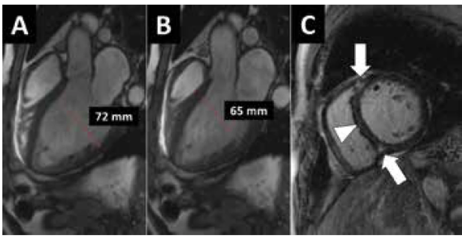 MR vyšetření dilatační KMP. 57 letý muž s těžkou systolickou dysfunkcí
levé komory bez významné koronární nemoci. A, B) Zobrazení MR sekvencí
„světlé krve“ ve 3-dutinové rovině v diastole (A) a v systole (B). Dilatace
a těžká systolická dysfunkce LK. C) Vyšetření pozdního nasycení gadoliniem
zobrazuje pouze nespecifická drobná ložiska v junkcích komor (šipky) a dále
diskrétní fibrózní změny v septu (hlava šipky).