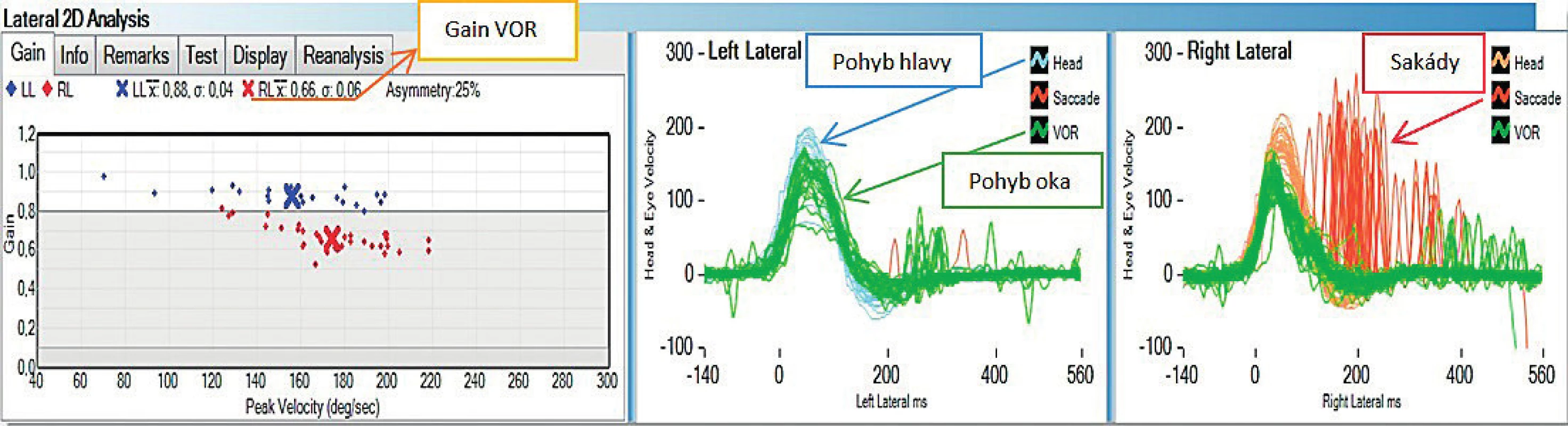 Grafické znázornění výsledků testu u zdravého jedince. Rychlost pohybu oka (zelená barva) koreluje s rychlostí pohybu hlavy
(modrá a oranžová barva). Diagram zobrazuje průměrnou hodnotu gainu VOR při testování jednotlivých polokruhovitých kanálků.
Popis polokruhovitých kanálků vnitřního ucha: RL (pravý laterální), LL (levý laterální), RA (pravý přední), LA (levý přední), RP (pravý zadní),
LP (levý zadní).