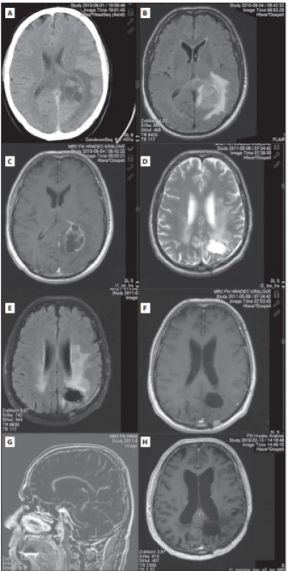 (A) Předoperační CT mozku s cystickou
expanzí vlevo okcipitálně a perifokálním edémem. (B,C) Předoperační MR mozku s objemnou cystickou expanzí okcipitálně vlevo (FLAIR
a postkontrastní T1). (D–G) Kontrolní MR (červen 2011) s nekolabovanou resekční dutinu
(D-axiální T2 obraz, E-axiální FLAIR, F-T1 po
kontrastní látce, axiální řez, G- sagitální subtrahovaný obrázek, tj. vzniklý odečtením T1 nativ od kontrastního T1 obrazu). Vyšetření prokazuje pouze lineární typ opacifi kace okraje
resekční dutiny, který patří mezi benigní typ
opacifi kace. Nebyl prokázán nodulární typ opacifi kace, který by svědčil pro přítomnost rezidua
či recidivy tumoru. Dále jsou přítomné trakční
změny vůči okcipitálnímu rohu levé postranní
komory. (H) Kontrolní MR mozku po 9 letech
(postkontrastní T1 obraz) bez jasného rezidua
tumoru s postiradiačními změnami bílé hmoty.<br>
Fig. 1. (A) Preoperative brain CT with cystic
expansion in the left occipital lobe with
perifocal edema. (B,C) Preoperative brain MRI
with cystic expansion in the left occipital lobe
(FLAIR and post-contrast T1). (D–G) Control
MR (June 2011) with non-collapsed resection
cavity (D-axial T2 image, E-axial FLAIR, F- postcontrast T1, axial, G-sagittal subtracted image,
i.e. resulting from subtracting T1 native from
the contrast T1 image). The examination
shows only linear type of opacification of
the resection cavity edge, which belongs to
a benign type of opacifi cation. No nodular
type of opacifi cation has been demonstrated
to indicate the presence of tumor residue or
recurrence. Furthermore, traction changes
are present relative to the occipital corner of
the left lateral ventricle. (H) Control brain MRI
after 9 years (post-contrast T1 image) without
clear tumor residuum with post-radiation
changes in the white matter.