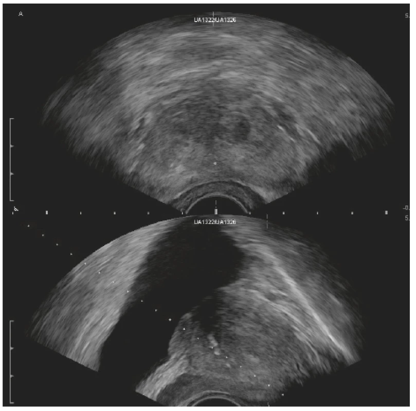 TRUS zobrazení prostaty – transversální řez (nahoře),
sagitální řez (dole). Zdroj: archiv autora