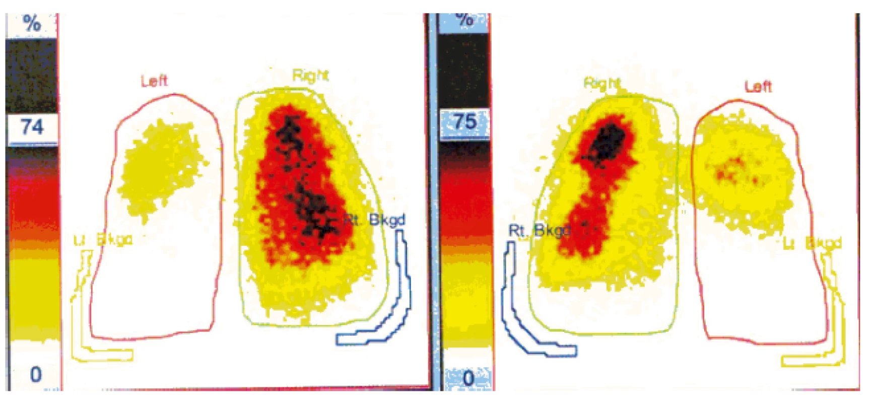 Scintigrafie plic, SPECT. Bilaterální plicní embolie: rozsáhlý defekt perfuze
v celém dolním laloku levé plíce a v části horního. Vpravo defekt v menším okrsku ve
středním laloku ventrálně