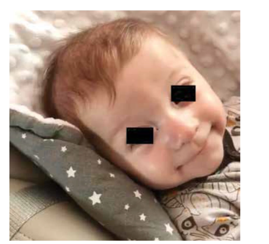 Spokojený prospívající 3měsíční chlapec.<br>
Fig. 2. Photo of the pacient – well growing happy infant,
3 month old.