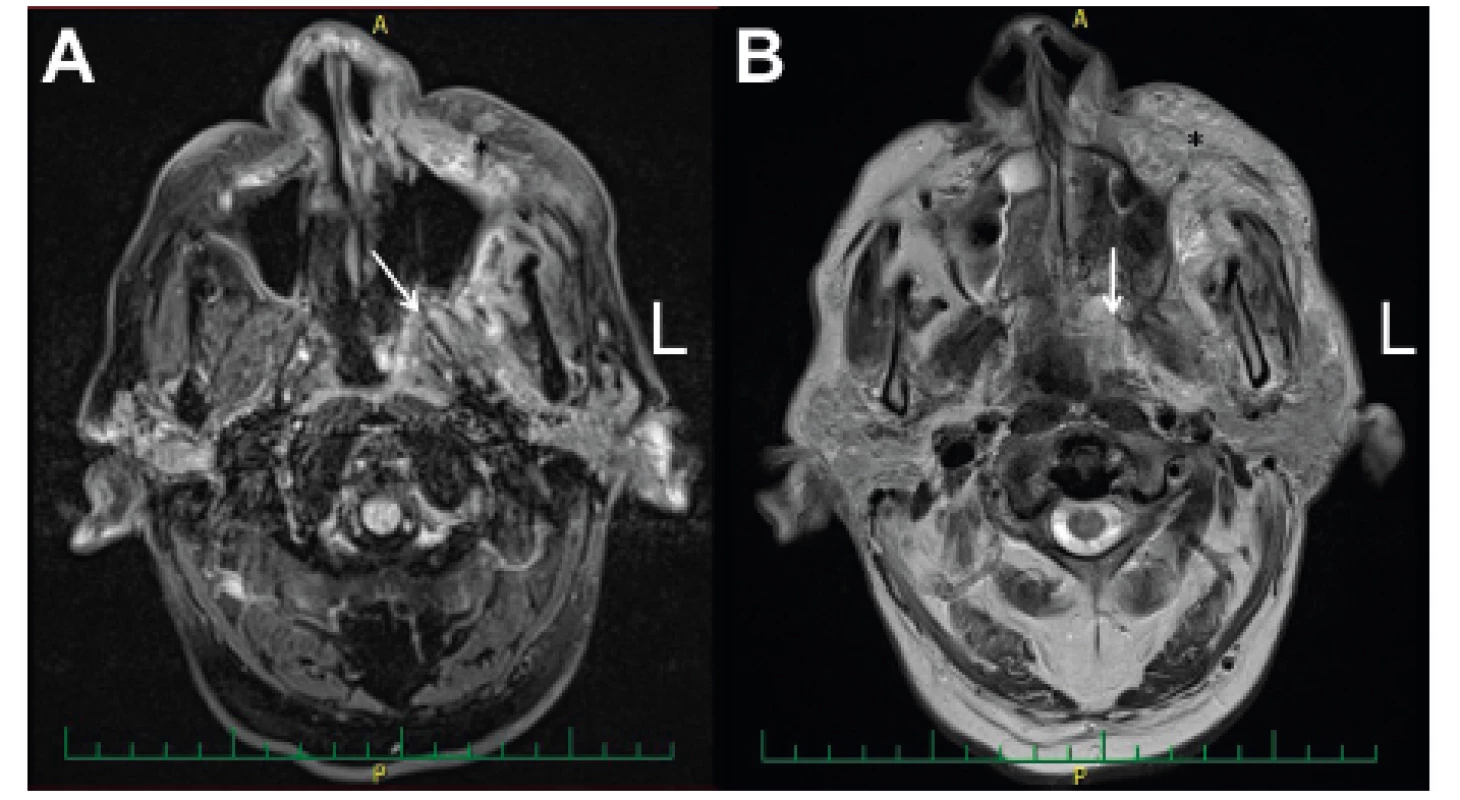 MRI vedlejších nosních dutin - předoperačně před radikálním
resekčním chirurgickým výkonem.<br>
A-T1 vážení (zánětlivá infiltrace fossa pterygopalatina (viz šipka)
a tkání levé tváře (viz *); B-T2 vážení (zánětlivá infiltrace tkání
fossa pterygopalatina (viz šipka) a tkání levé tváře (viz *)