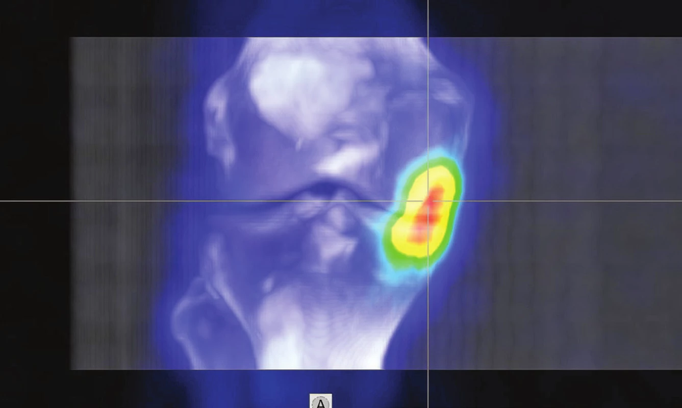 3D fúze SPECT/CT obrazu u pacienta s osteochondrálním
defektem mediálního kondylu femuru v pozdějším stádiu a s přestavbovou
aktivitou i protilehlého konce tibie.