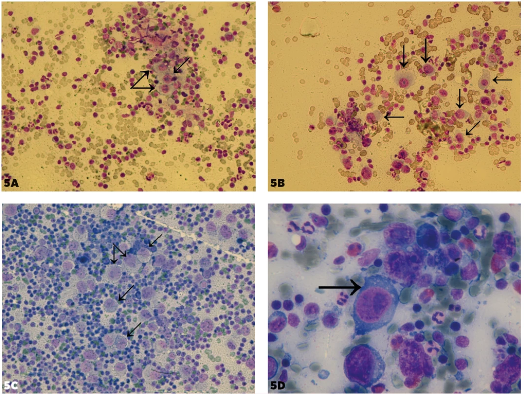 Porovnanie Hodgkinovych buniek pri klasickom Hodgkinovom lymfóme (cHL) a buniek podobných Hodgkinovym bunkám pri metastázach
pri malom zväčšení. 5A (zväčšenie 200x), 5B (zväčšenie 400x) – Hodgkinove bunky pri cHL. 5C – bunky podobné Hodgkinovym pri metastáze
klasického seminómu, zväčšenie 400x. 5D – bunka podobná Hodgkinovej na reaktívnom pozadí lymfocytov, plazmocytov a eozinofilov (ktoré je
typické pre Hodgkinov lymfóm) pri metastáze veľkobunkového epidermoidného karcinómu, zväčšenie 1000x. Časť týchto buniek je vyznačených
šípkami.