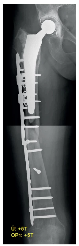 Selhání osteosyntézy 5 týdnů od operace<br>
Fig. 3: Implant failure 5 weeks after surgery