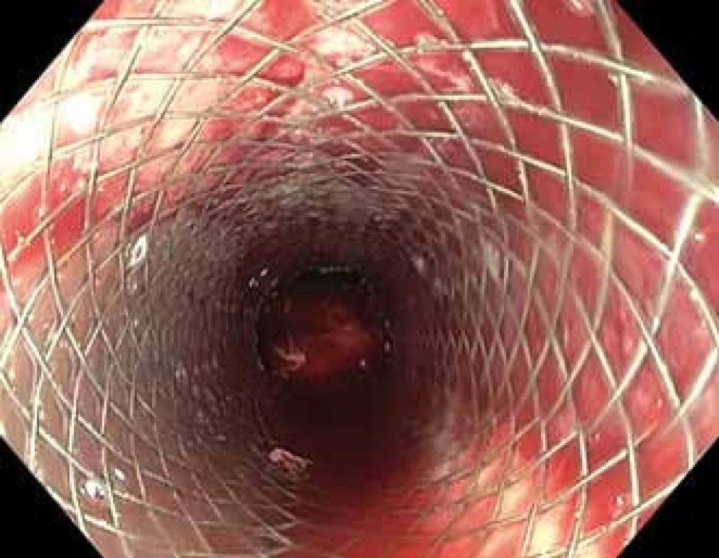 Celopotažný metalický stent jícnu překrývající zdroj krvácení.<br> Fig. 2. Self-expandable metallic stent covering the source of bleeding.