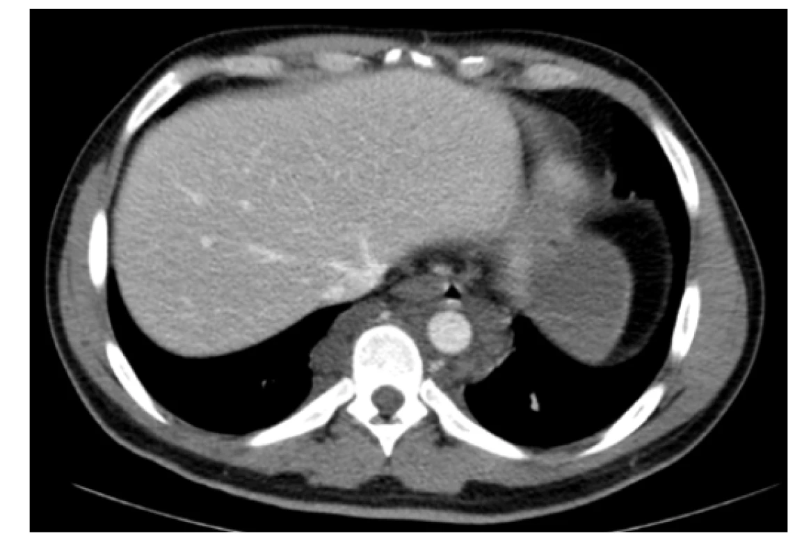 Kontrastní CT scan (axiální rovina) – patologická masa v hrudníku
prevertebrálně a paraaortálně
