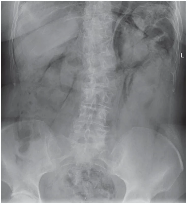 Prostý snímek břicha vleže – masivní pneumoperitoneum po koloskopii.<br>
Fig. 2. Plain X-ray of the abdomen, prone – with a massive pneumoperitoneum
after colonoscopy.